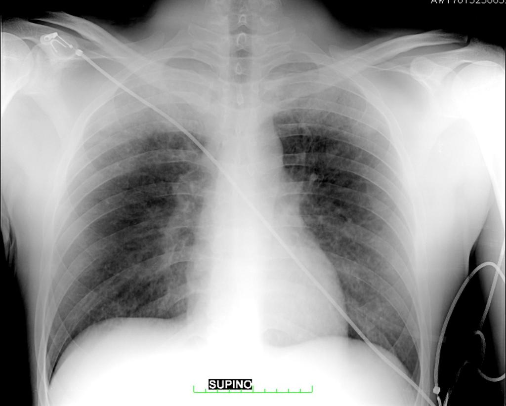 Conclusion Near- drowning diagnosis is based on anamnestic history, but chest X- ray gives information about pulmonary involvment and is an useful tool in monitoring therapy response.