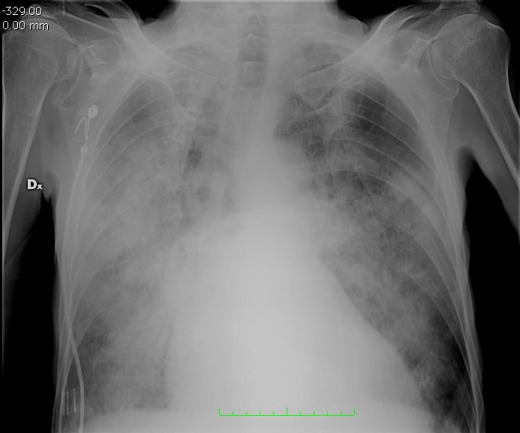 50 cases); several factors associated with the pathophysiology of near-drowning likely determine the probability that pneumonia will develop.