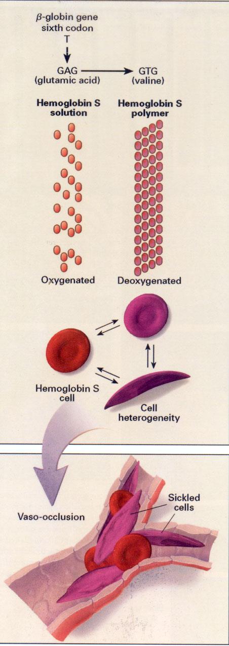 Pathophysiology of sickle cell disease β 6 Glu Val" Deoxy Hb S polymer forms with low O 2, depends on Hgb S concentration, low ph, high temperature,