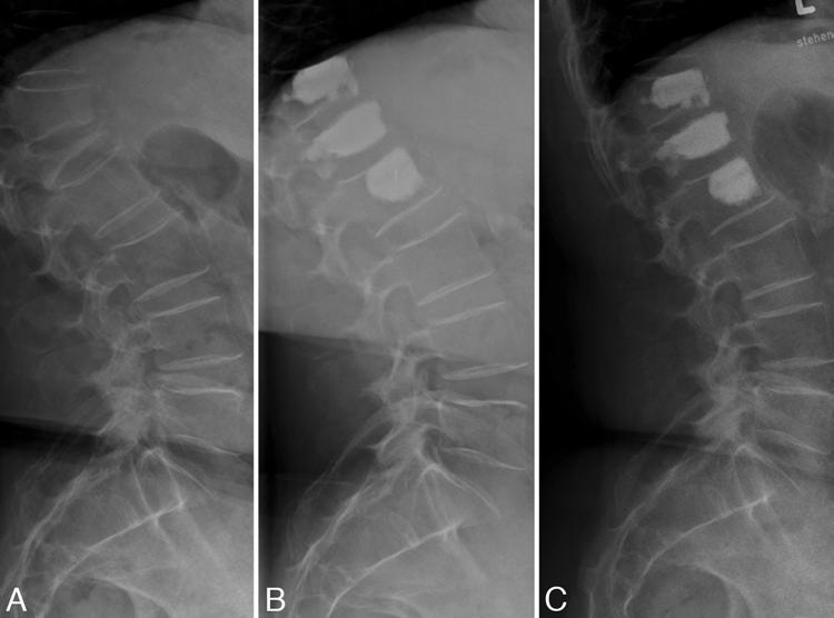 Midterm outcome of lordoplasty Fig. 2. Standing lateral radiographs obtained in a 65-year-old woman with a severe osteoporotic L-1 compression fracture. A: Preoperative image.