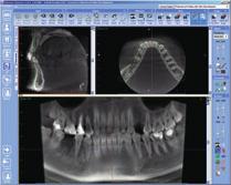 implant. The drawing tool allows clear marking of the mandibular nerve.