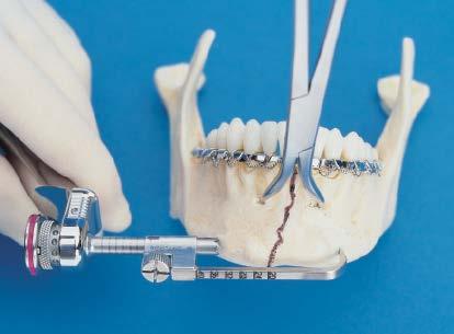 Precaution: Position the device so that the predetermined drill path avoids tooth roots.