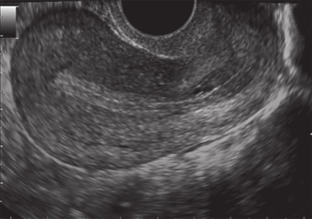 A Two-year Cross-sectional Prospective Study for Assessment of Endometrial Thickness and Volume using 3-D TVUS Data sampling was done based on the quality not grouping and based on previous articles,