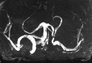 Fig. 1. Magnetic resonance angiography study demonstrating occlusion of the left ICA but normal configuration of the bifurcation of the BA. Examination.