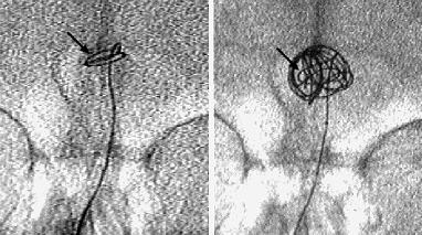 Then the microcatheter was retracted, and its tip was shaped into a simple angle so that we could introduce and/or retrieve it easily. The microcatheter was reinserted into the aneurysm, and three No.