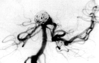 Fig. 6. Postoperative left VA angiogram demonstrating an occlusion of the upper two thirds of the lesion. Ten No. 18 GDCs with a total length of 156 cm were placed in the aneurysm.