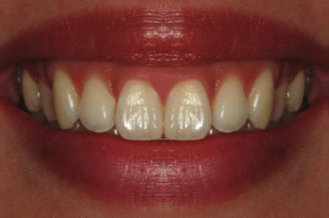 International Dentistry 3 Figure 3: Asymmetric black triangle. Figure 5: Control photograph (photo A). Figure 4: Unacceptable asymmetric long contact.