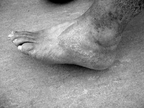 Arterijski ulkus na stopalu lijeve noge RASPRAVA Venski ulkusi nogu nastaju kao