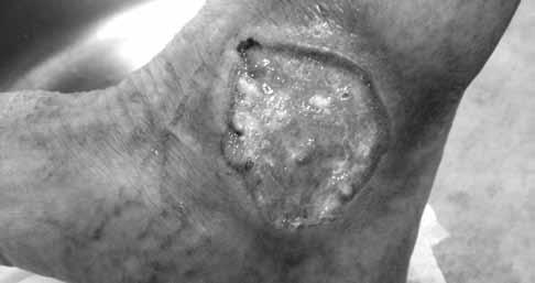 VASKULITIS SREDNJE VELIKIH KRVNIH ŽILA (Polyarteritis nodosa) najčešće se prikazuje bilateralno na potkoljenicama kao livedo racemosa s bolnim nodusima duž arterija i ulceracijama te purpurom.