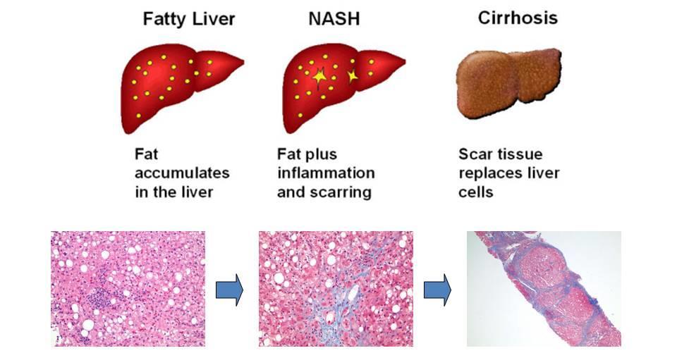 What is Non-Alcoholic Fatty Liver Disease (NAFLD) and Non-Alcoholic Steatohepatitis (NASH)?