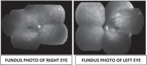 Dr Sandhya N MS, Dr. Mahesh G. MS, FRCS (Ed) Introduction are chronic anterior uveitis and acute herpetic retinitis.