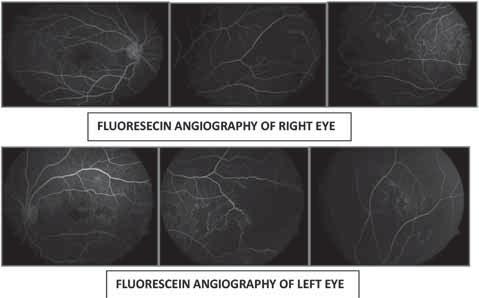 The media was clear. There was a well demarcated area of were multiple cotton wool spots all over the fundus. The optic disc and retinal vessels were normal.