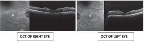 Sandhya & Mahesh: Oculsive Retinal Vasculopathy inner retinal layers due to ischemia 2. retinal whitening at the posterior pole.