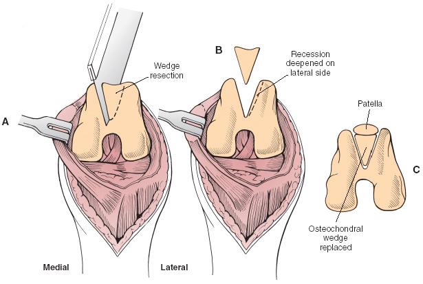 Trochlear Wedge Recession This procedure also deepens the trochlear groove while preserving the articular cartilage.