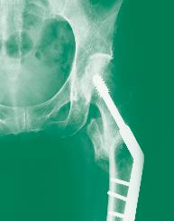 April 2015 Lower extremity fractures: Updates and problems Periprosthetic