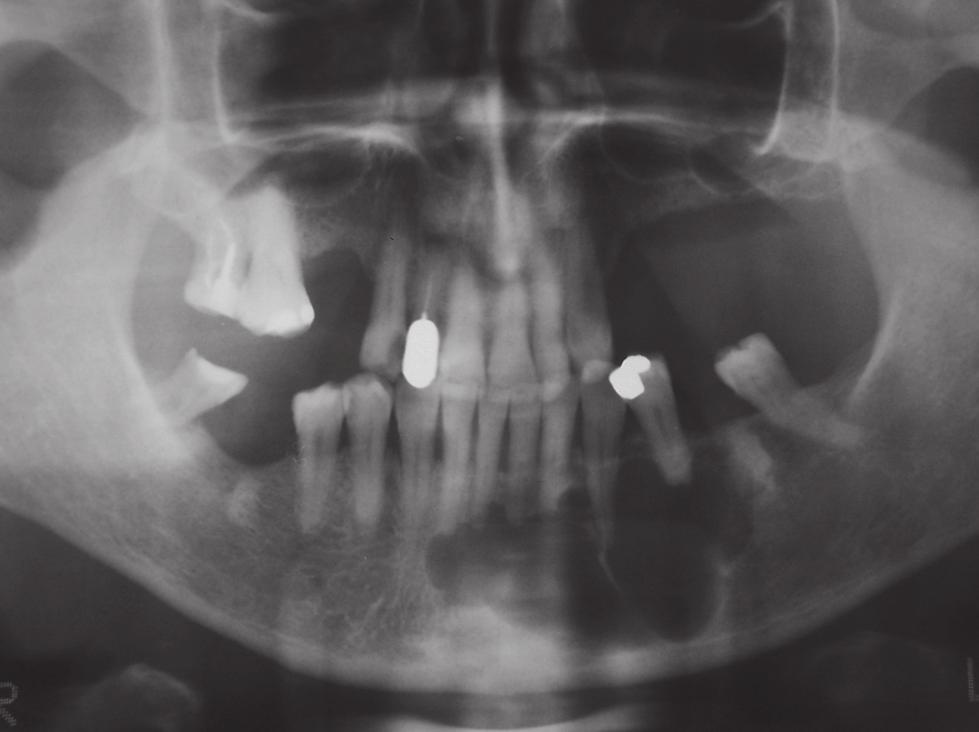 swelling area in the premolar and molar zone, where the patient has been complaining of mild pain.