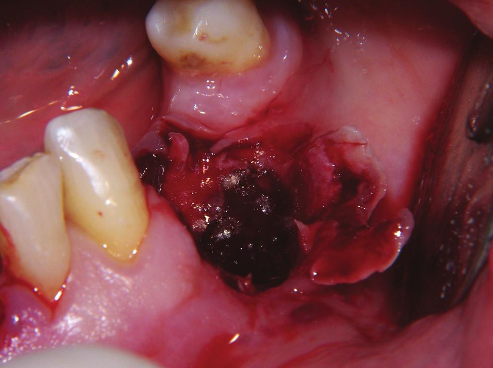 a well-defined unilocular radiotrasparency with radiopaque margins extending from the central incisor