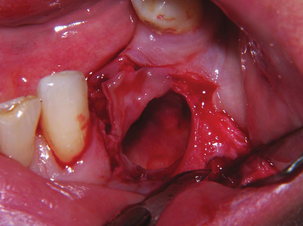 No signs of displacement of the roots were observed Figure 3: This image shows the lesion after flap