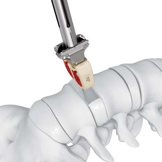 Implant Insertion Option A: Using Aiming Device Insert implant Optional Instrument SFW69R Prodisc-L Combined Hammer Confirm the aiming device/implant connection is locked into position.