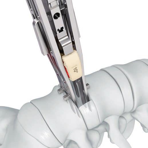 Implant Insertion Option B: Using Squid Inserter/Distractor With the spindle engaged, turn the T-handle on the Evolution SQUID Inserter/Distractor to advance the implant down the paddles and into the