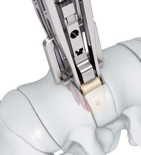 Under fluoroscopic control continue turning the T-handle until the SYNFIX Evolution Implant is fully ejected and released from the Evolution SQUID Inserter/Distractor ().