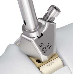 Attach Removal Tool to Implant Optional instrument 03.80.