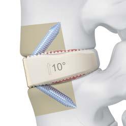 The superior stability of the SYNFIX LR Implant is shown compared to other standalone ALIF implants.