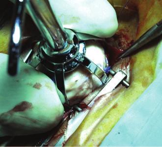 The Scientific World Journal 3 (a) (c) Figure 2: Insertion of the bioceramic prothesis. (a) The partially covered implant is inserted. (b) The marked pole is in front.