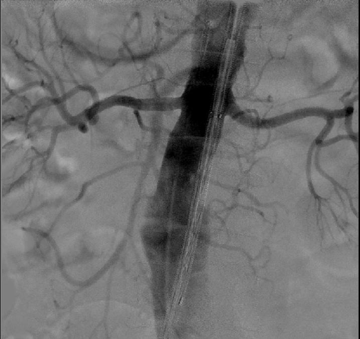 Few ml of Iodinated Contrast to