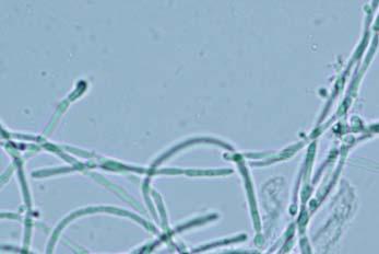 Wet Prep Microscopic View What is the most likely cause of her problem? A. Candida krusei B.