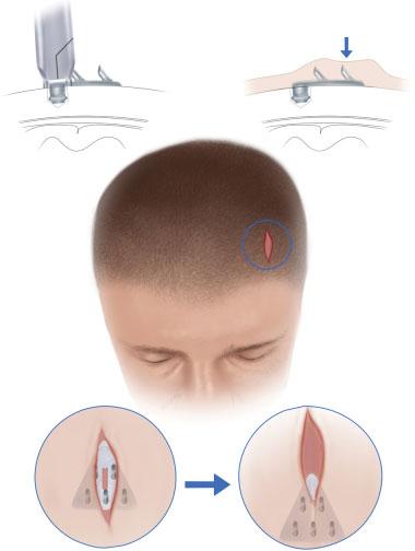 Options in Repositioning the Asymmetric Brow from Paralysis and Trauma Lee et al. 637 attached to the anterior scalp flap, and secured ( Fig. 14).