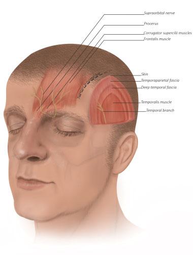 Options in Repositioning the Asymmetric Brow from Paralysis and Trauma Lee et al. 629 Fig.