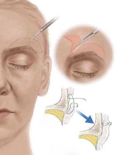 If targeting the ptotic brow, one can either inject the depressor supercilli to raise the medial brow or the lateral orbicularis oculi to raise the lateral brow.