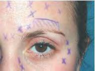 Forehead Treat 1-2 cm above orbital rim to minimize risk brow ptosis