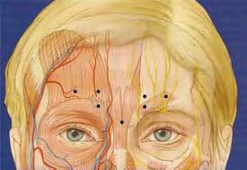 Glabella Traditional injection sites Mang W. Manual of aesthetic surgery-1. Springer 2002.