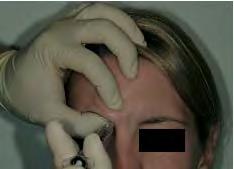 Dose-ranging of botulinum toxin type A in the treatment of glabellar rhytids in females. Dermatol Surg April 2005;31(4):414-22.