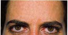Glabella-post treatment Complications Eyelid ptosis Prevention-inject 1 cm above orbital rim Niamtu J. Complications in fillers and botox. Oral Maxillofac Surg Clin North Am. Feb 2009;21(1):13-21.