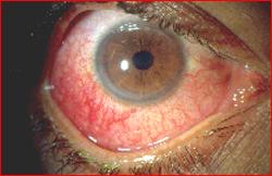 Acute anterior uveitis Visual acuity Pain Discharge/ watering Hyperaemia Cornea AC Iris Pupils