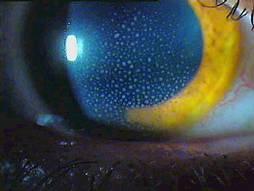 Circum corneal Transparent precipitates may be present posterior surface depth/ white blood