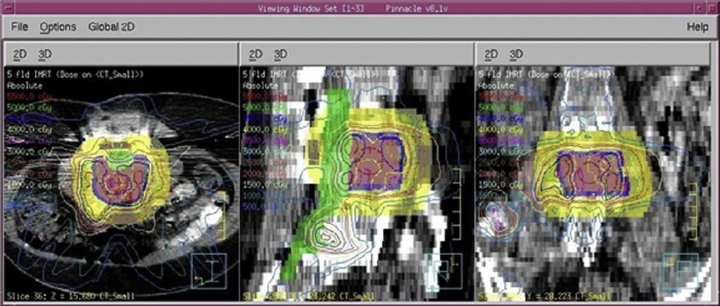 Combined modality Therapy Isodose contours in Pinnacle showing the combined therapy treatment plan.