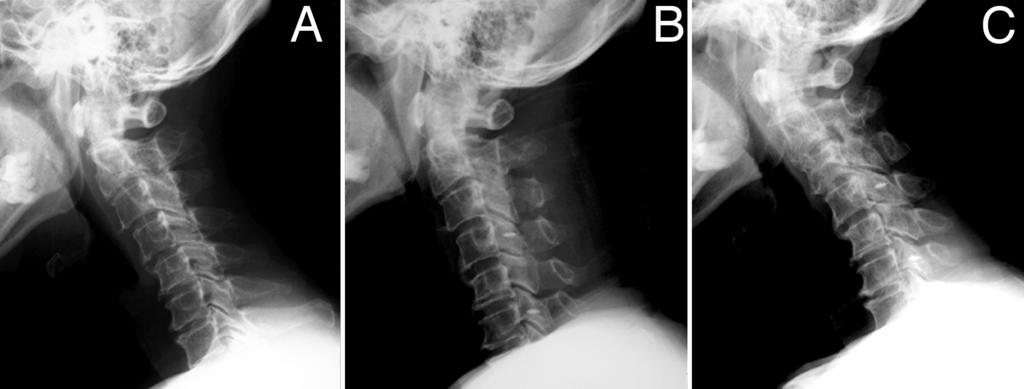 Lamina closure after open-door laminoplasty Fig. 6. Lateral radiographs obtained in a 70-year-old man with preoperative kyphosis in whom lamina closure developed despite the use of anchor screws.