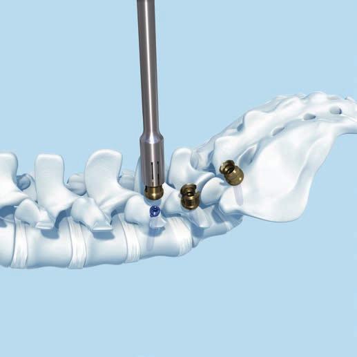 5 Attach Click X 3-D heads and assemble construct Prior to attaching the 3-D heads ensure that the pedicle screw heads are clean and not contaminated with any bone cement.