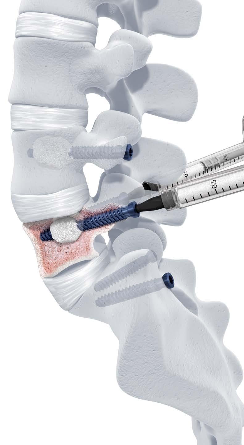 Perforated Click X. Augmentable pedicle screws for osteoporotic bone.