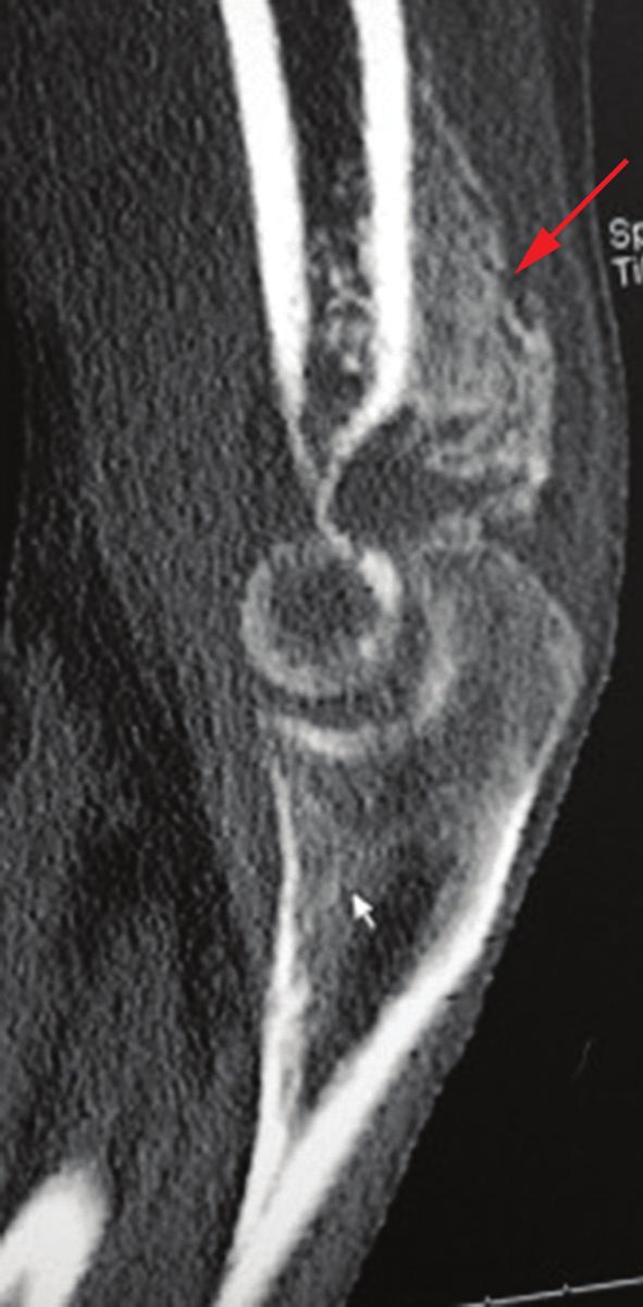 Early Arthroscopic Management of Heterotopic Ossification of the Elbow 253 A B Figure 25-2.