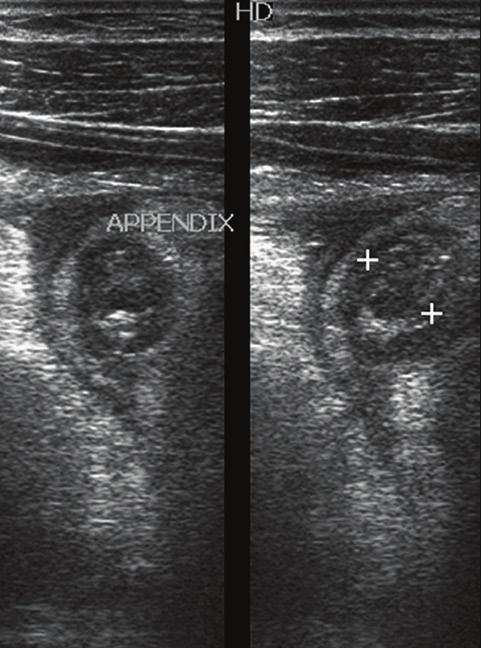 lesions causing acute abdomen requiring ultrasonography for diagnosis, to establish accuracy of ultrasonography in diagnosis of acute abdomen and to describe ultrasonographic features of various