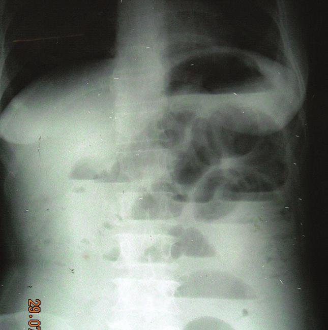 Figure-7: Plain radiograph abdomen showing dilated bowel loops with multiple air-fluid levels suggestive of obstruction.