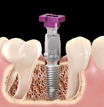 There are many reasons to opt for a restoration at either the implant or abutment level, especially now that digital solutions are available.