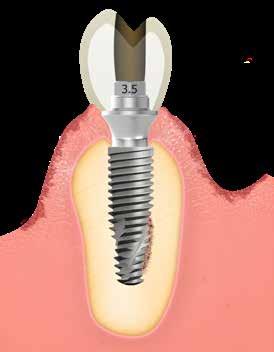 2.2 Type of retention: cement-retained or screw-retained prosthesis Dental implant prosthesis can either be cement-retained or screw-retained, depending on the clinical situation and the preference