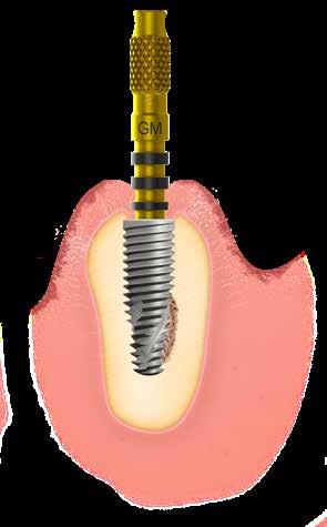 4.2 Biological care when placing Grand Morse abutments and prosthetic components Grand Morse abutments are normally