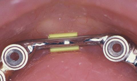Implant Pilot Holes 16 to 18mm Center-to-Center Split the